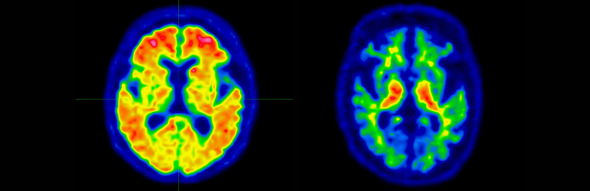 UNM Hospital Bringing More Diagnostic Options to Patients with Memory Loss