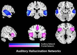 Schizophrenia patients who frequently hallucinate were given a brain scan and the team identified two key brain networks related to their hallucinations.