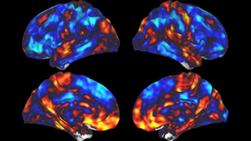 UNM researcher awarded $2 million grant to use brain stimulation to help treat aphasia