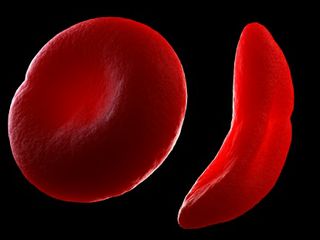 Sickle cell disease: Normal red blood cell (left) and sickled red blood cell (right)