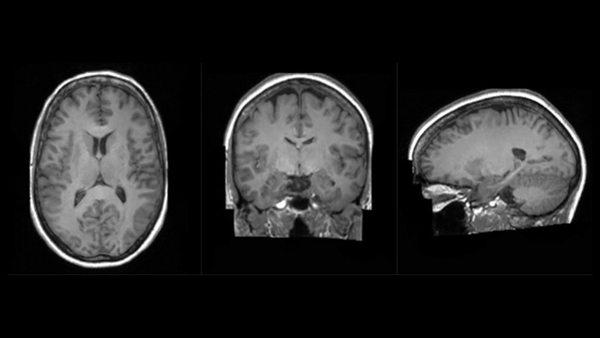Brain scans performed by King's College London