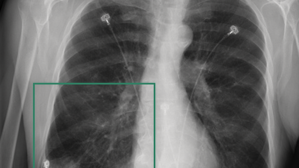 Medical AI Reasoning