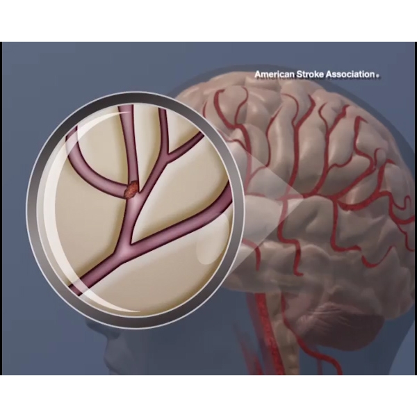 clot+in+the+brain