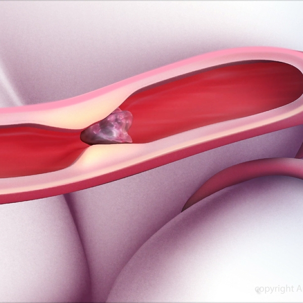 Clot+in+brain+illustration