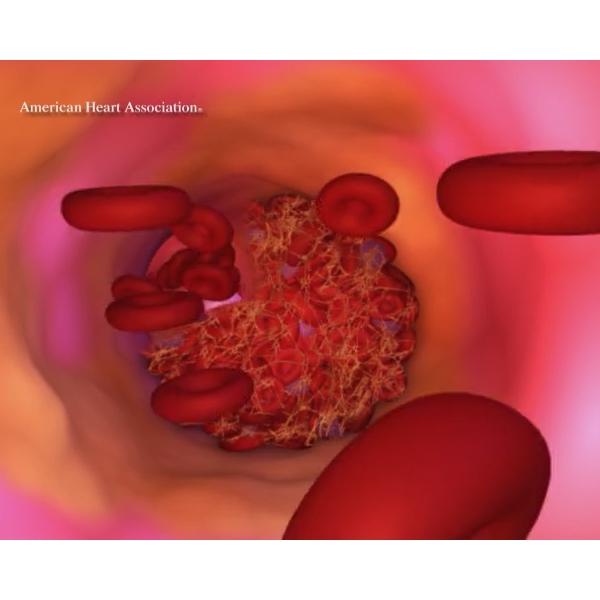 Atherosclerosis+-+clot+formation