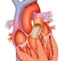 OHSU fixes complex heart problems without open-heart surgery
