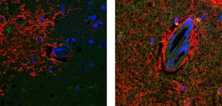 Alzheimers Cognitively Vessels