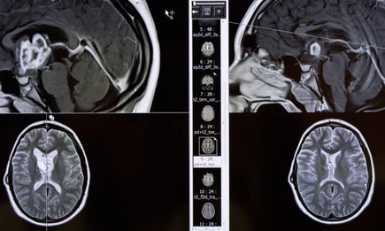 DCH Pediatric Brain Tumor Board