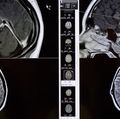 DCH Pediatric Brain Tumor Board