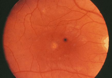 Casey Eye Institute