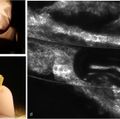 New research on root canal treatment