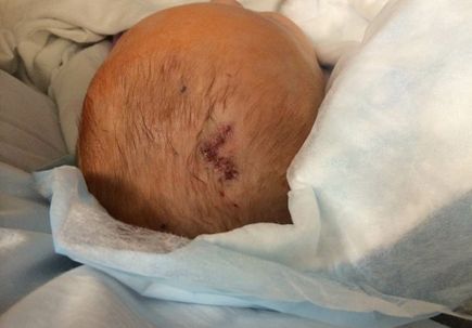 Hydrocephalus: ETV Incision