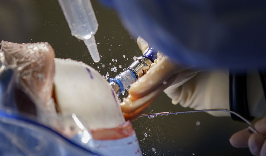 A surgeon drills through a 3-D printed model of a skull, as he trains with a brain surgery simulator.