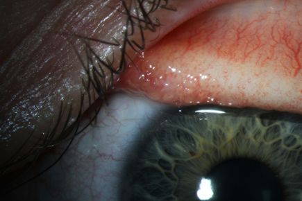 Thelazia gulosa - cattle eyeworm