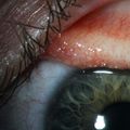 Thelazia gulosa - cattle eyeworm