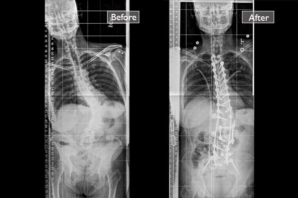 xray image on left shows a spine with a sharp 's' curve. X-ray on right shows straightened spine with rods and screws holding it in place.
