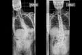 Spinal reconstruction