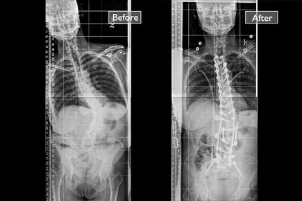 Spinal reconstruction