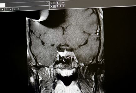 Pituitary clinical trial