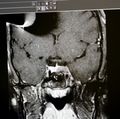 Pituitary clinical trial