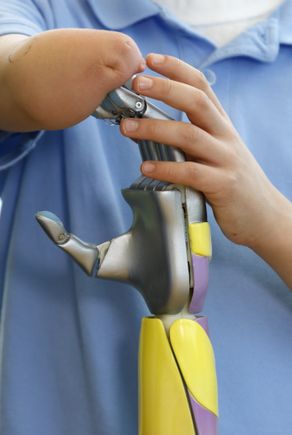 Bionic arm clinical trial