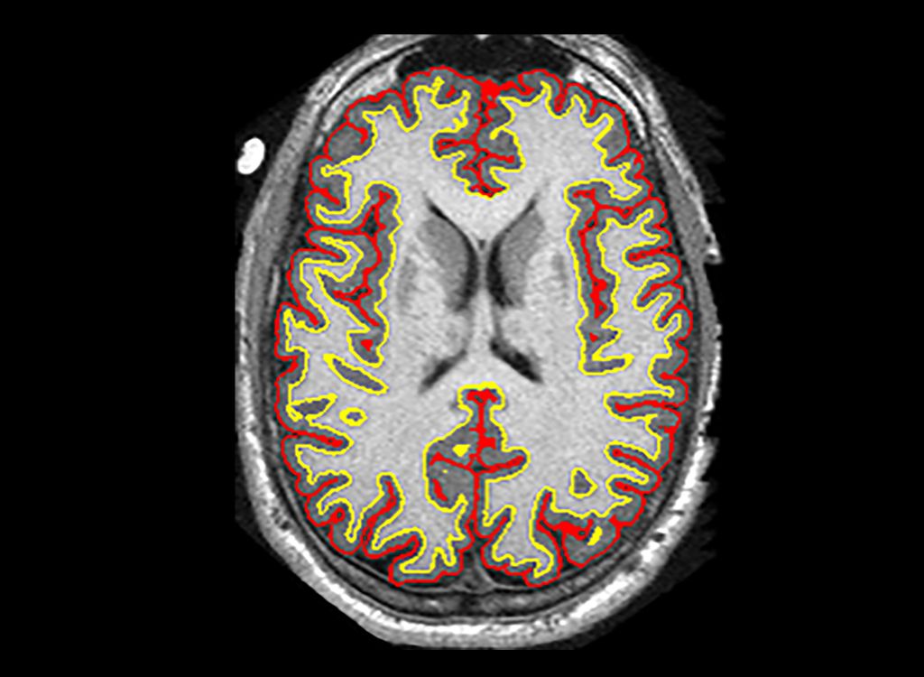 Slowing MS brain shrinkage