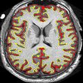 Patients with multiple sclerosis may benefit from over-the-counter therapy