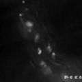 VIDEO DOWNLOAD: Cardio vein platelette