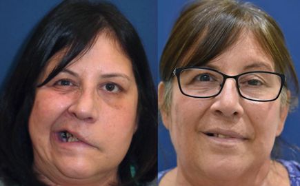 Facial reanimation - before and after