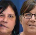 Facial reanimation - before and after