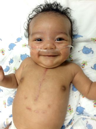 Pediatric congenital heart defect