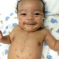 Pediatric congenital heart defect