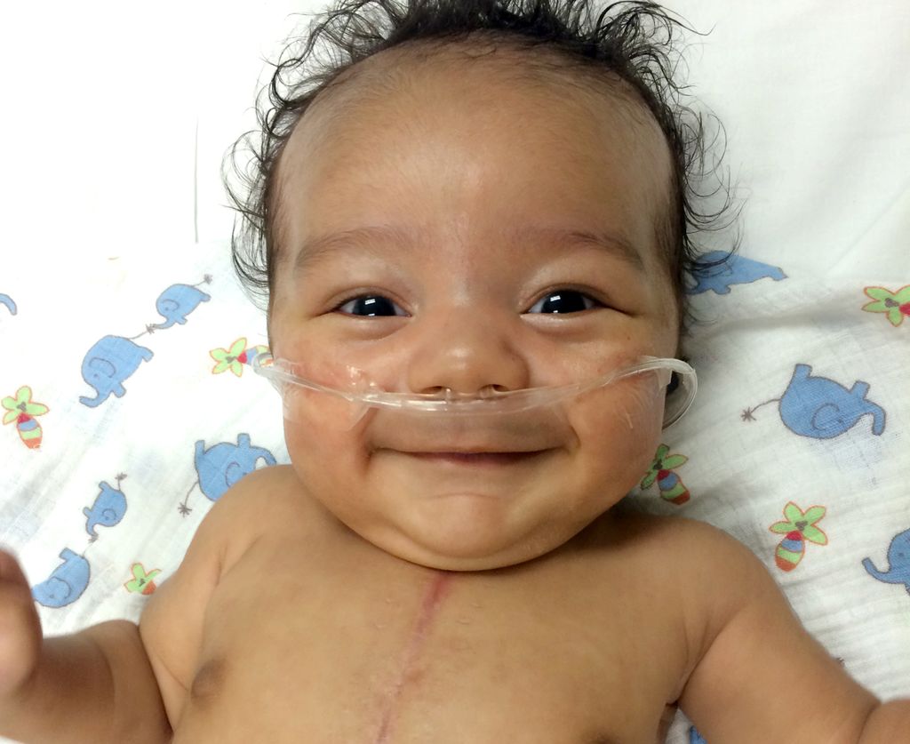 image of smiling baby, with a large scar on chest, and wearing oxygen tube in nose