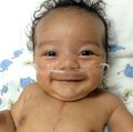 Pediatric congenital heart defect