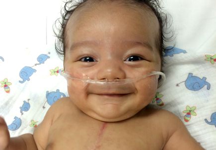 Pediatric congenital heart defect