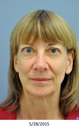 Thyroid eye disease treatment
