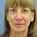 Thyroid eye disease treatment