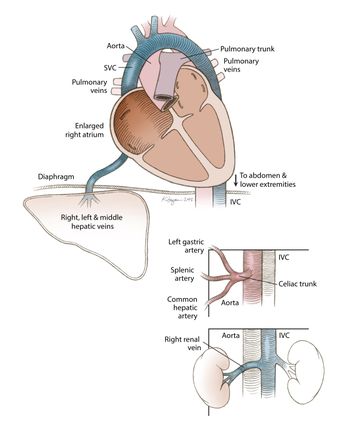 Situs inversus with levocardia