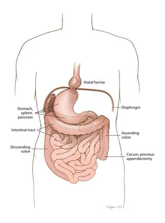 Situs inversus with levocardia