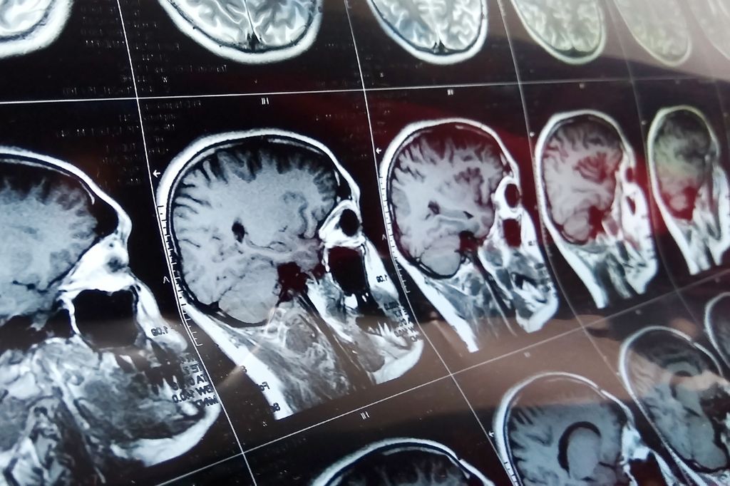 image of brain MRI