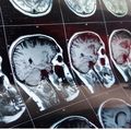 LGBTQ awareness lacking among American neurologists, new survey finds
