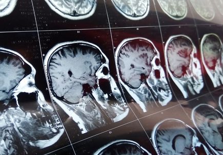 Neurology