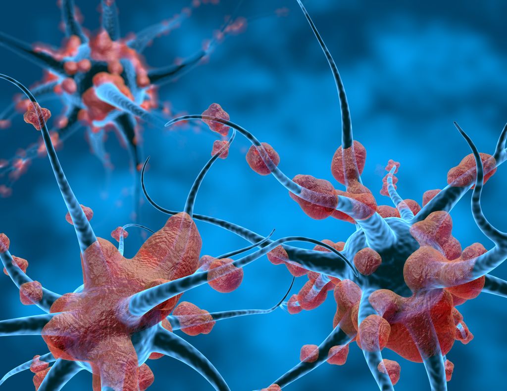 illustration of neurons with damaged myelin sheath
