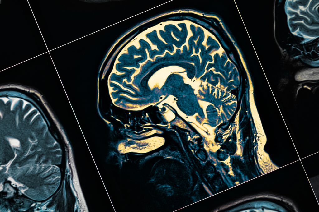 a closeup of a mri of a brain
