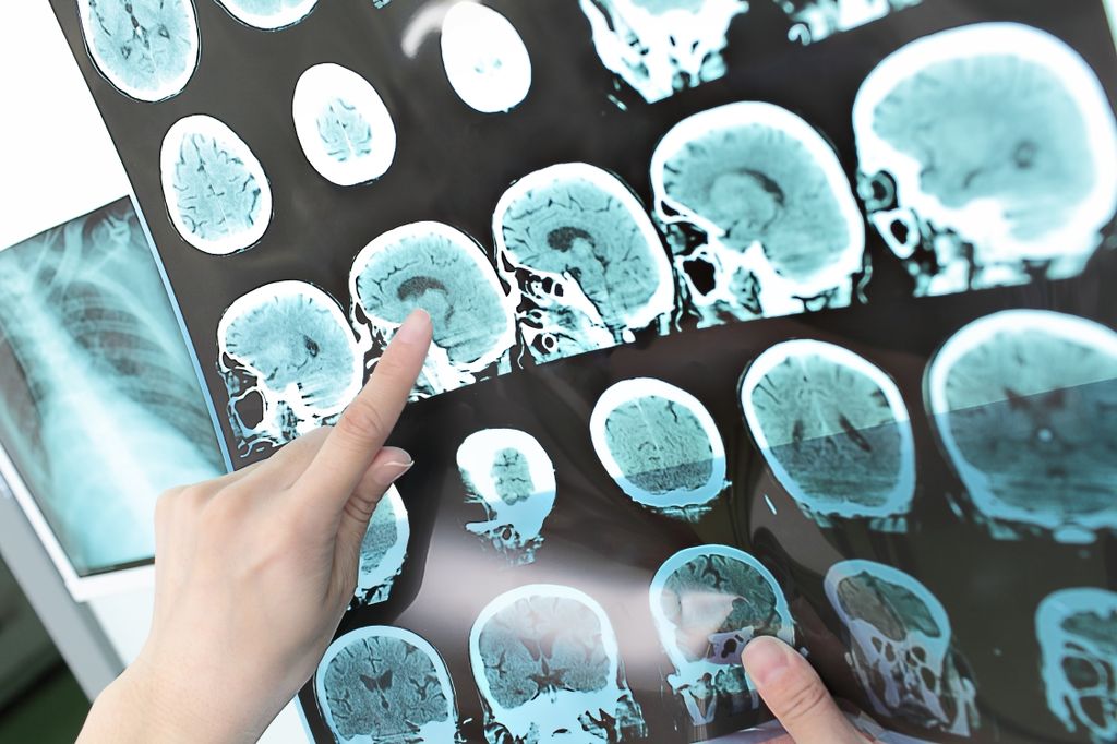 Medical image of stroke victim's brain (CT scan)
