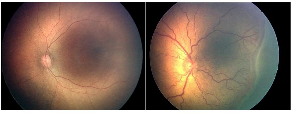 Two close-up images of a human eye, set side-by-side, show two opaque, black-lit orbs that have red vessels growing throughout. The eye image to the right has more pronounced vessels, as would be found for those with the condition retinopathy of prematurity.