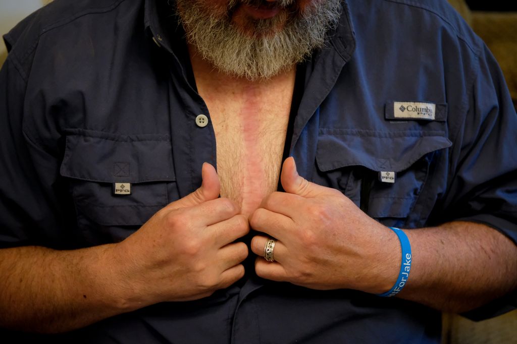 A man opens pulls apart his button-down shirt to reveal a wide scar that runs down the center of his chest.