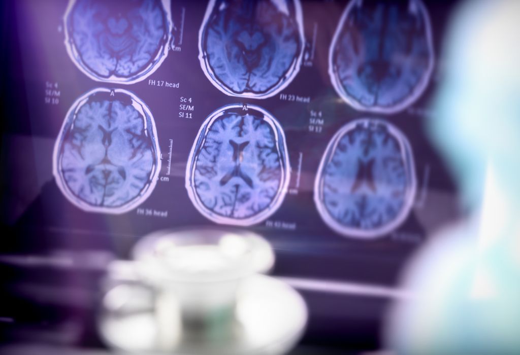Fecal implants drive behavioral and cognitive changes in Alzheimer's model. Image is an x-ray image of a brain to show changes.