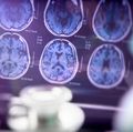 Fecal implants drive behavioral and cognitive changes in Alzheimer's model
