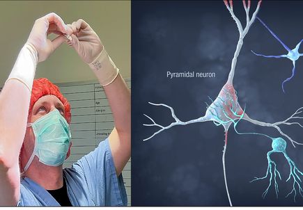OHSU second in the country to perform regenerative brain cell therapy procedure